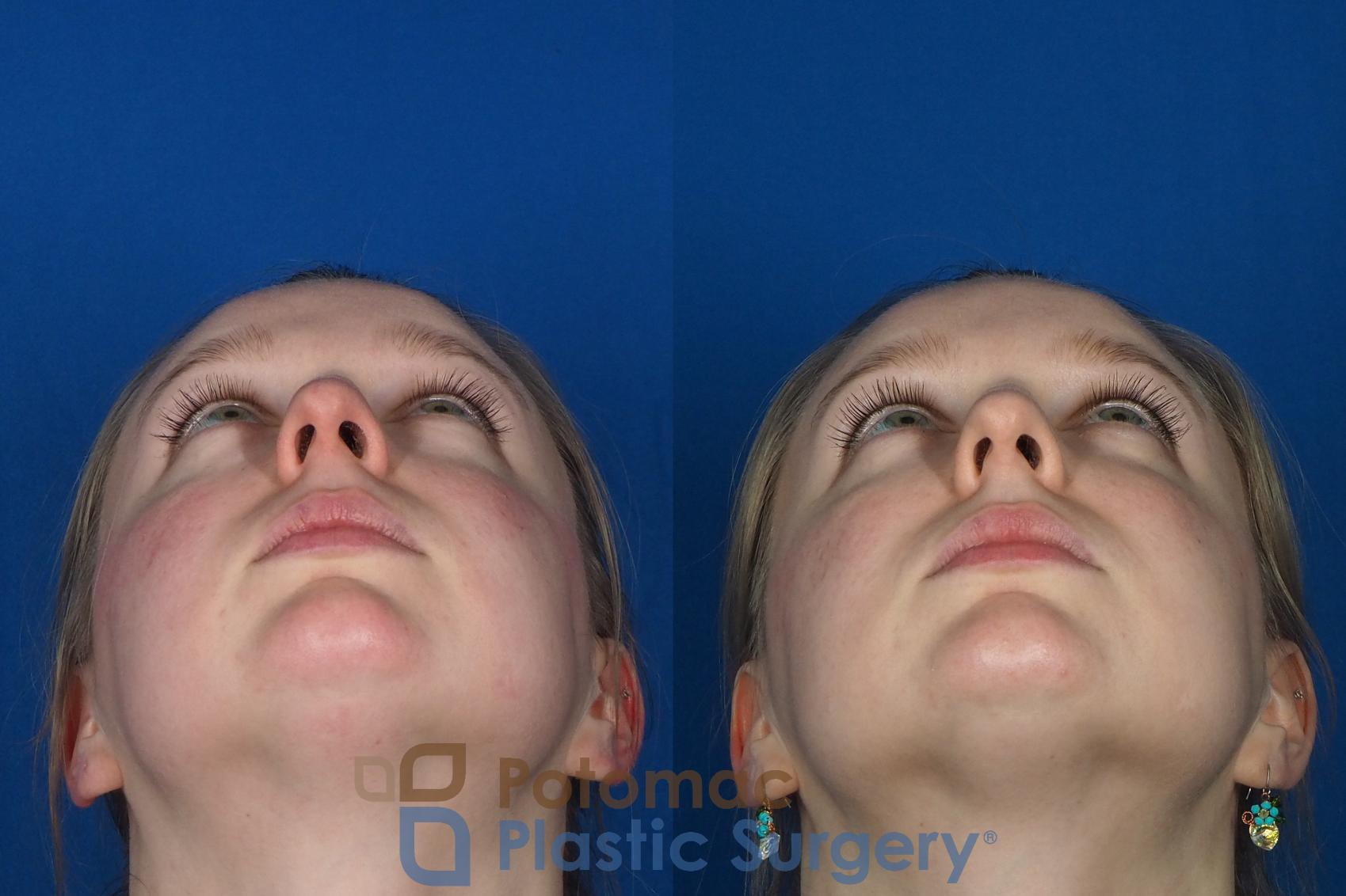 Before & After Dermal Fillers Case 231 Bottom View in Washington, DC