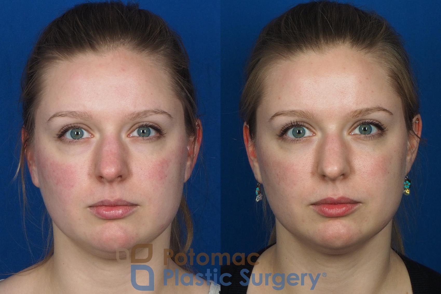 Before & After Cheek Augmentation Case 231 Front View #1 View in Washington, DC