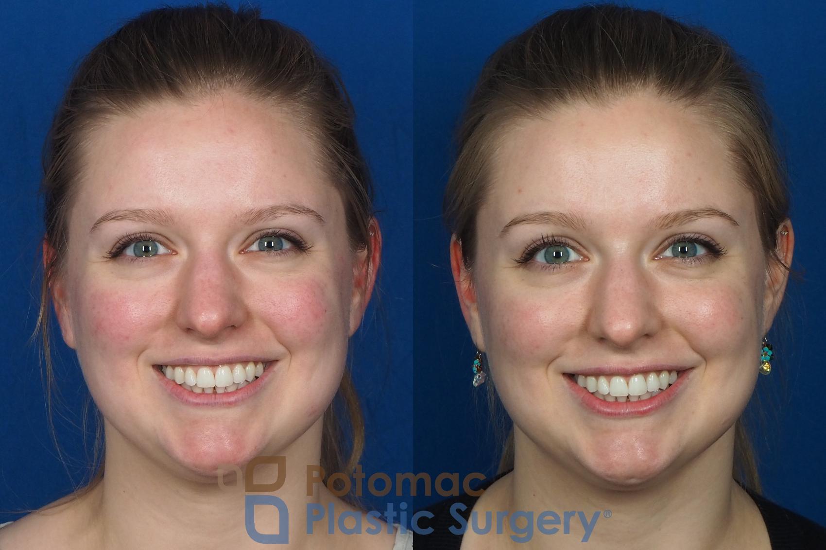 Before & After Dermal Fillers Case 231 Front View #2 View in Washington, DC