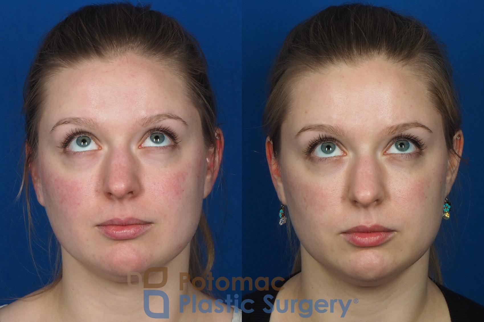 Before & After Dermal Fillers Case 231 Front View #3 View in Washington, DC