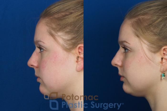 Before & After Cheek Augmentation Case 231 Left Side View in Washington DC & Arlington , DC