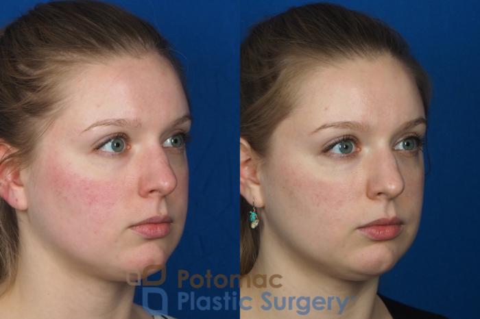 Before & After Cheek Augmentation Case 231 Right Oblique View in Washington DC & Arlington , DC