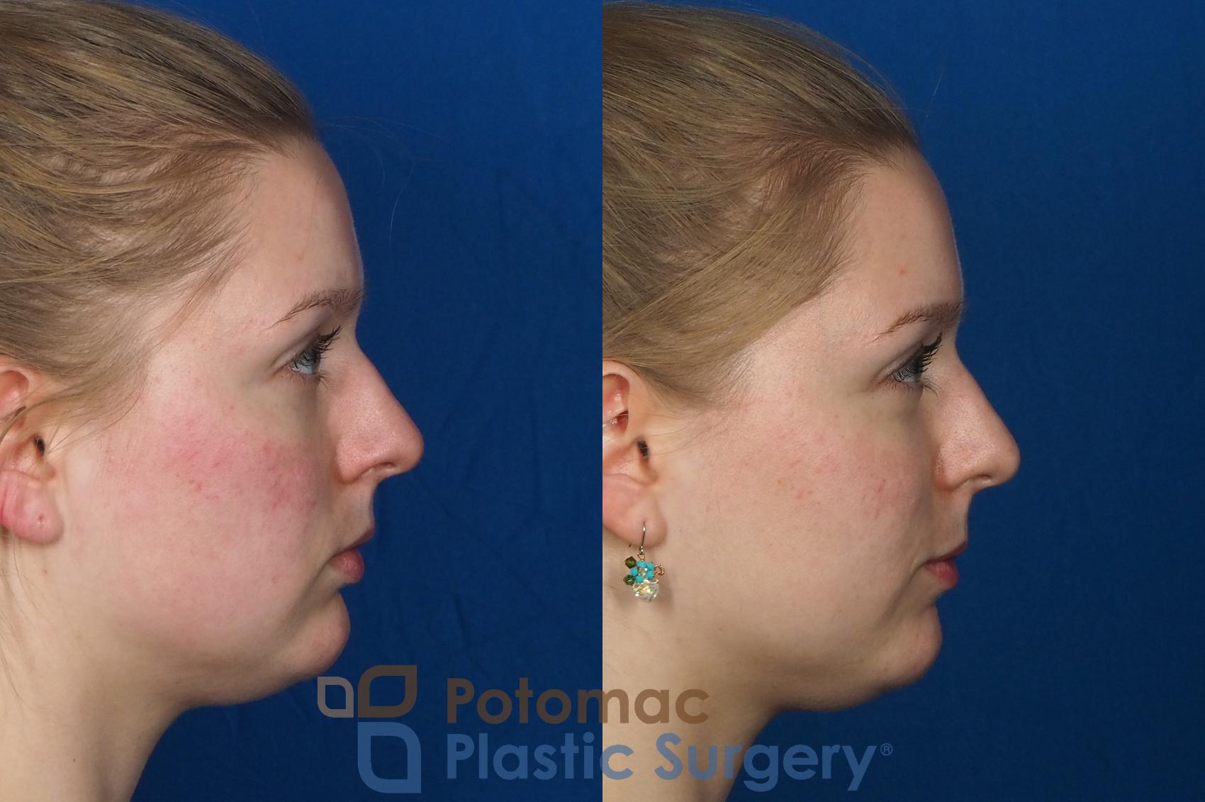 Before & After Dermal Fillers Case 231 Right Side View in Washington, DC