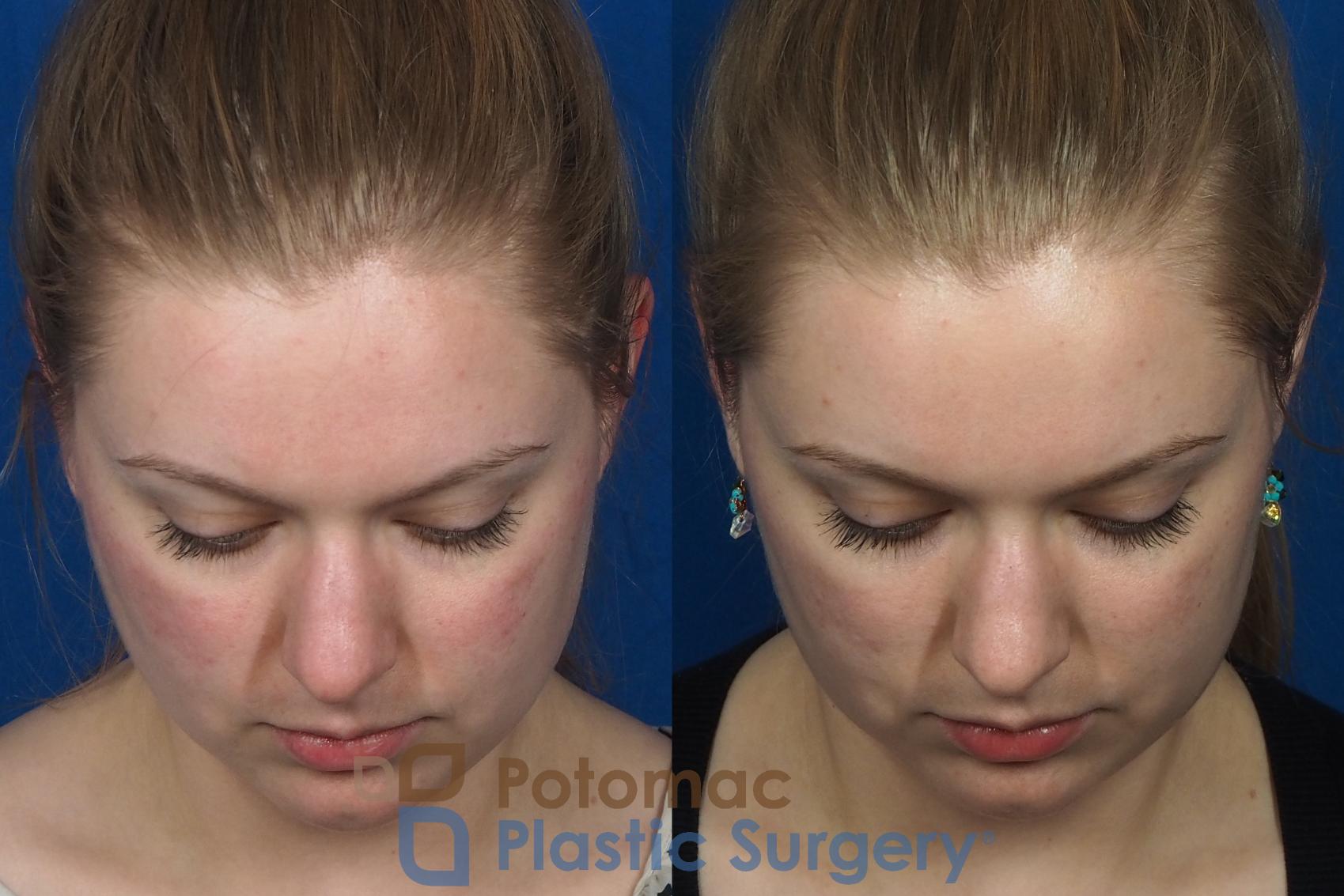 Before & After Dermal Fillers Case 231 Top View in Washington, DC
