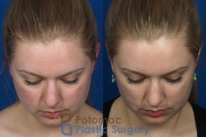 Before & After Dermal Fillers Case 231 Top View in Washington DC & Arlington , DC