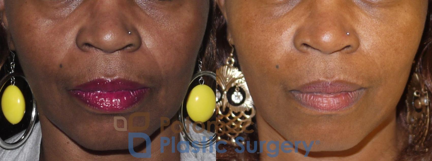 Before & After Dermal Fillers Case 30 Front View in Washington, DC