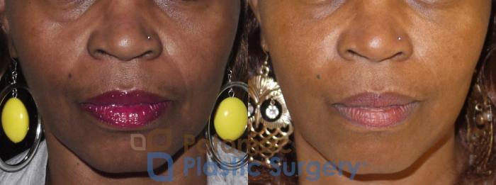 Before & After Dermal Fillers Case 30 Front View in Washington DC & Arlington , DC