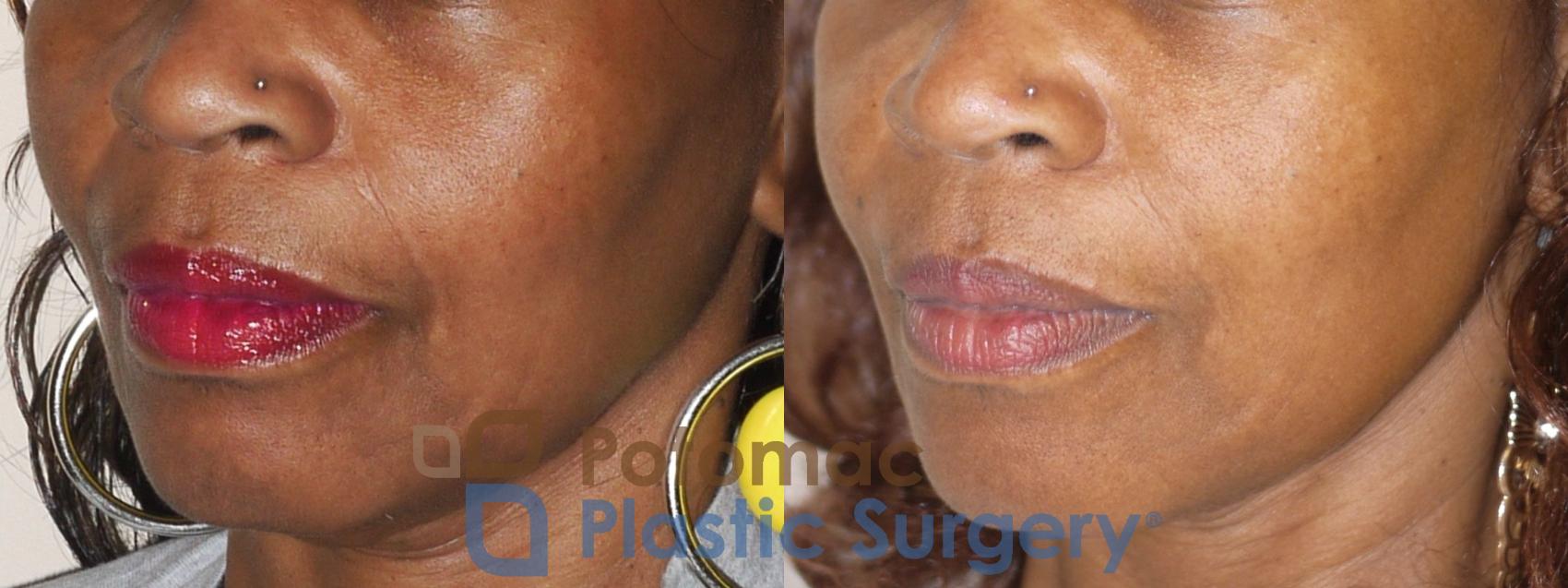 Before & After Dermal Fillers Case 30 Left Oblique View in Washington DC & Arlington , DC