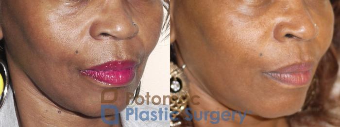 Before & After Liquid Facelift Case 30 Right Oblique View in Washington DC & Arlington , DC