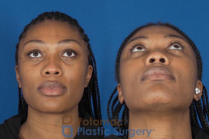 Before & After Liquid Facelift Case 304 Bottom View in Washington DC & Arlington , DC