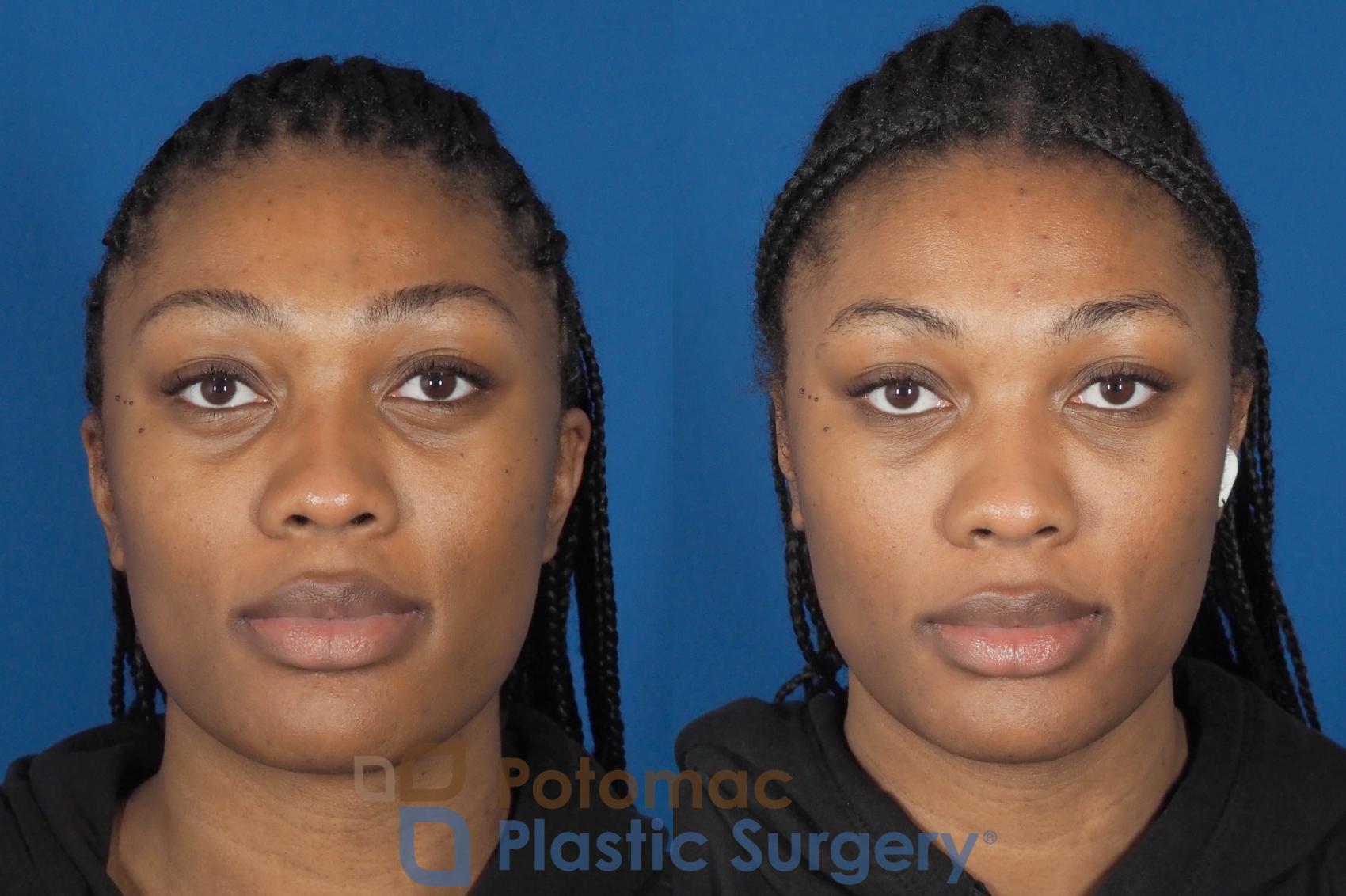 Before & After Liquid Facelift Case 304 Front View in Washington, DC