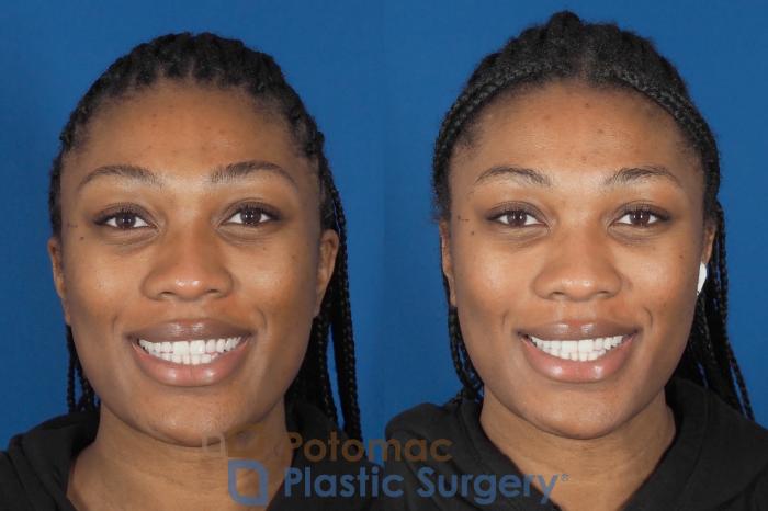 Before & After Liquid Facelift Case 304 Front - Smiling View in Washington DC & Arlington , DC