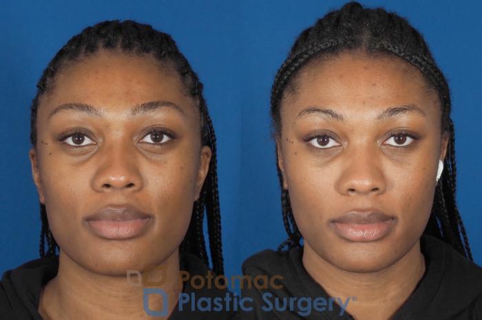 Before & After Liquid Facelift Case 304 Front View in Washington DC & Arlington , DC