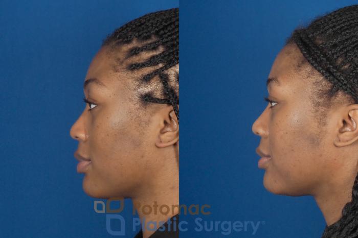 Before & After Dermal Fillers Case 304 Left Side View in Washington DC & Arlington , DC