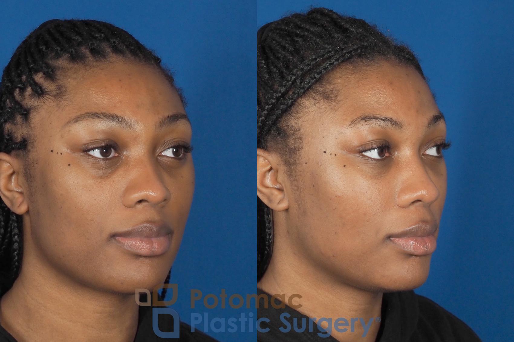 Liquid facelift with injections to enhance face of young woman