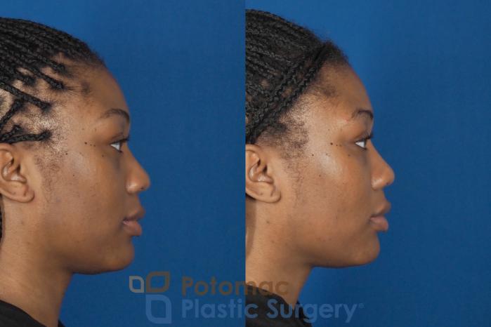 Before & After Dermal Fillers Case 304 Right Side View in Washington DC & Arlington , DC