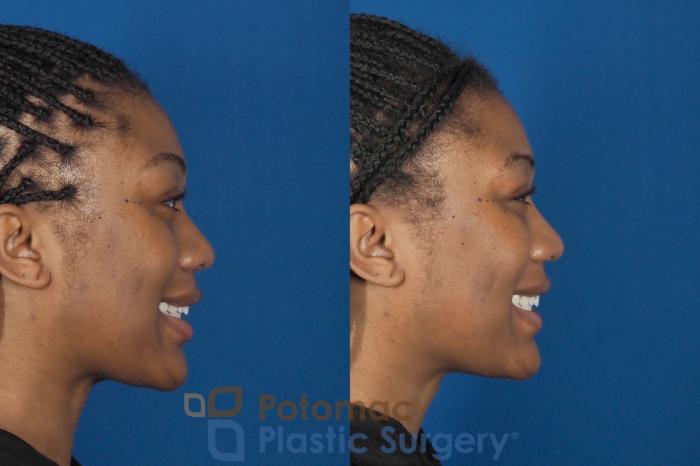 Before & After Liquid Facelift Case 304 Right - Smiling View in Washington DC & Arlington , DC