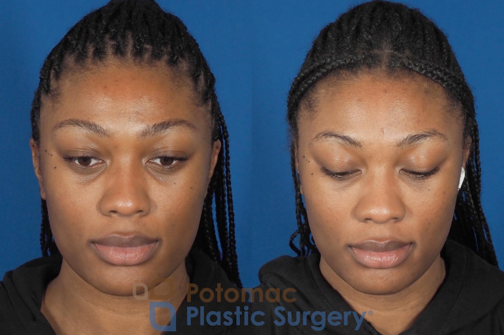 Before & After Dermal Fillers Case 304 Top View in Washington DC & Arlington , DC