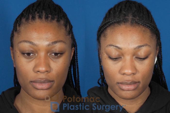 Before & After Liquid Facelift Case 304 Top View in Washington DC & Arlington , DC