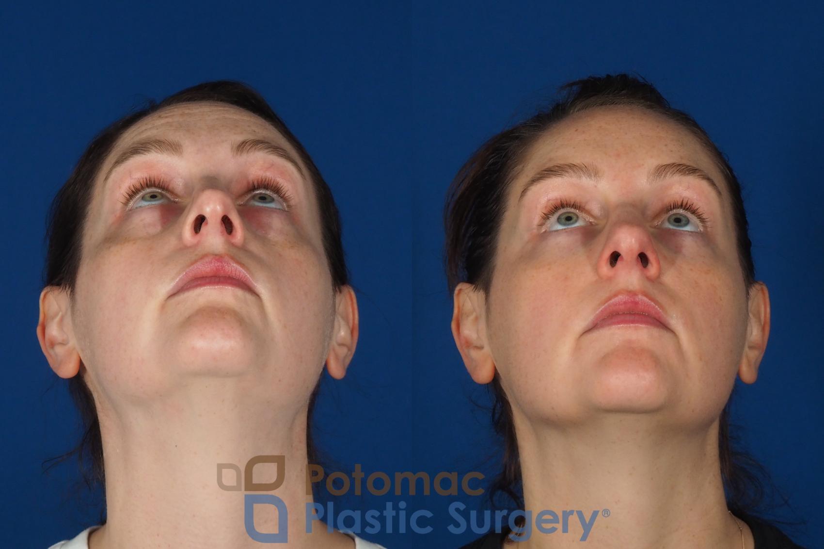 Before & After Dermal Fillers Case 332 Bottom View in Washington DC & Arlington , DC