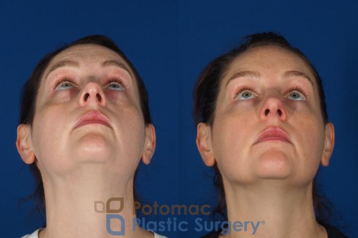 Before & After Liquid Facelift Case 332 Bottom View in Washington DC & Arlington , DC