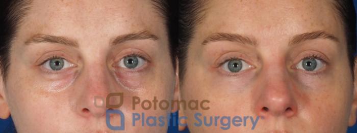 Before & After Dermal Fillers Case 332 Front 2 View in Washington DC & Arlington , DC