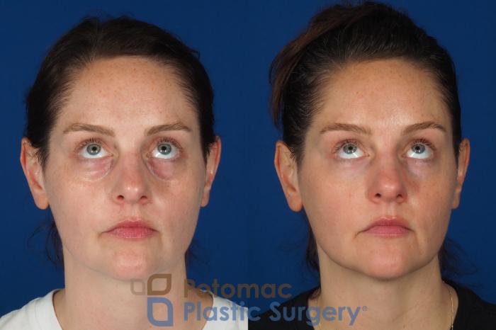 Before & After Liquid Facelift Case 332 Front - Looking Up View in Washington DC & Arlington , DC