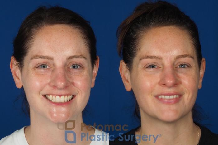Before & After Liquid Facelift Case 332 Front - Smiling View in Washington DC & Arlington , DC