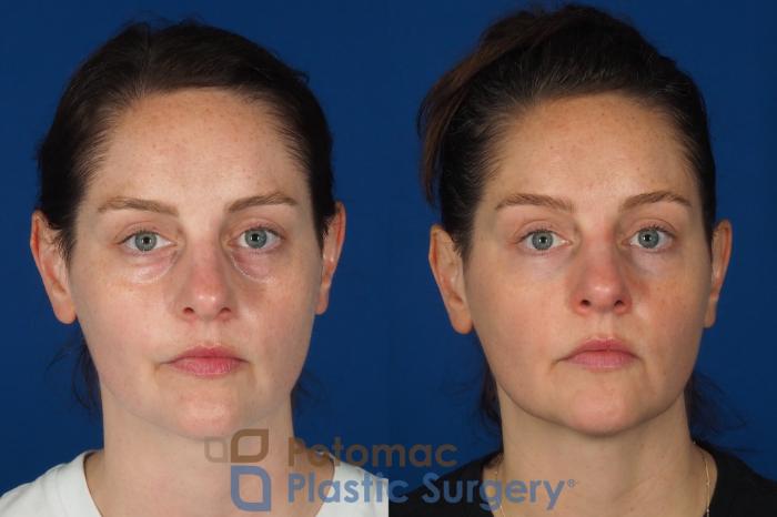 Before & After Liquid Facelift Case 332 Front View in Washington DC & Arlington , DC