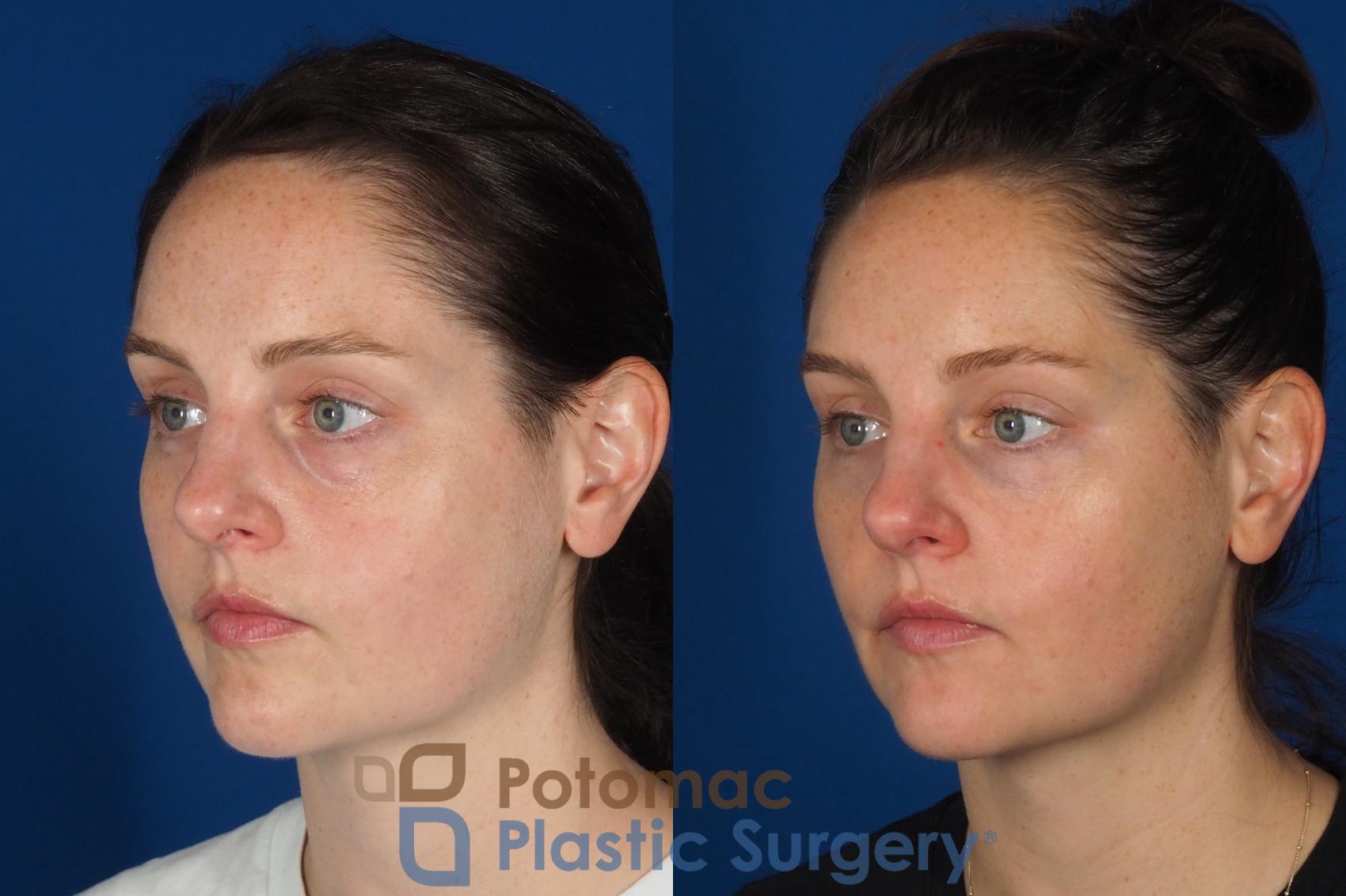 Before & After Dermal Fillers Case 332 Left Oblique View in Washington DC & Arlington , DC