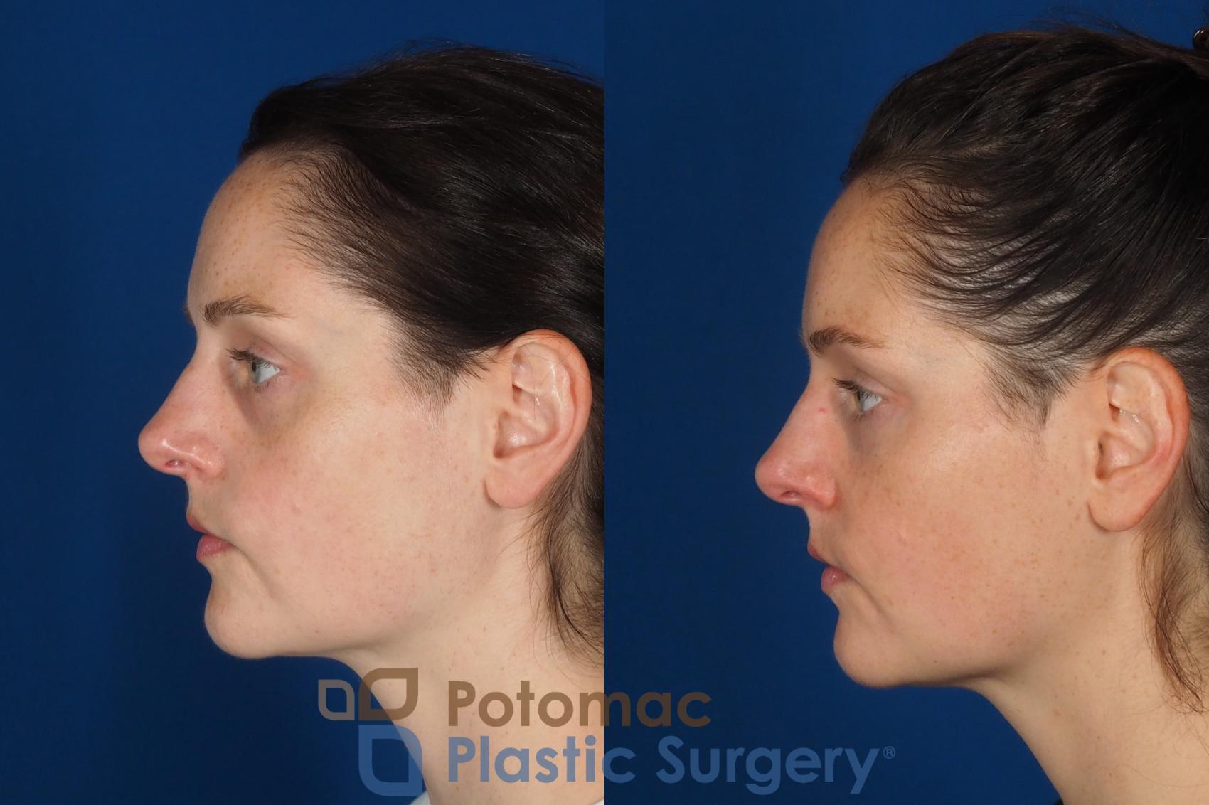 Before & After Dermal Fillers Case 332 Left Side View in Washington DC & Arlington , DC