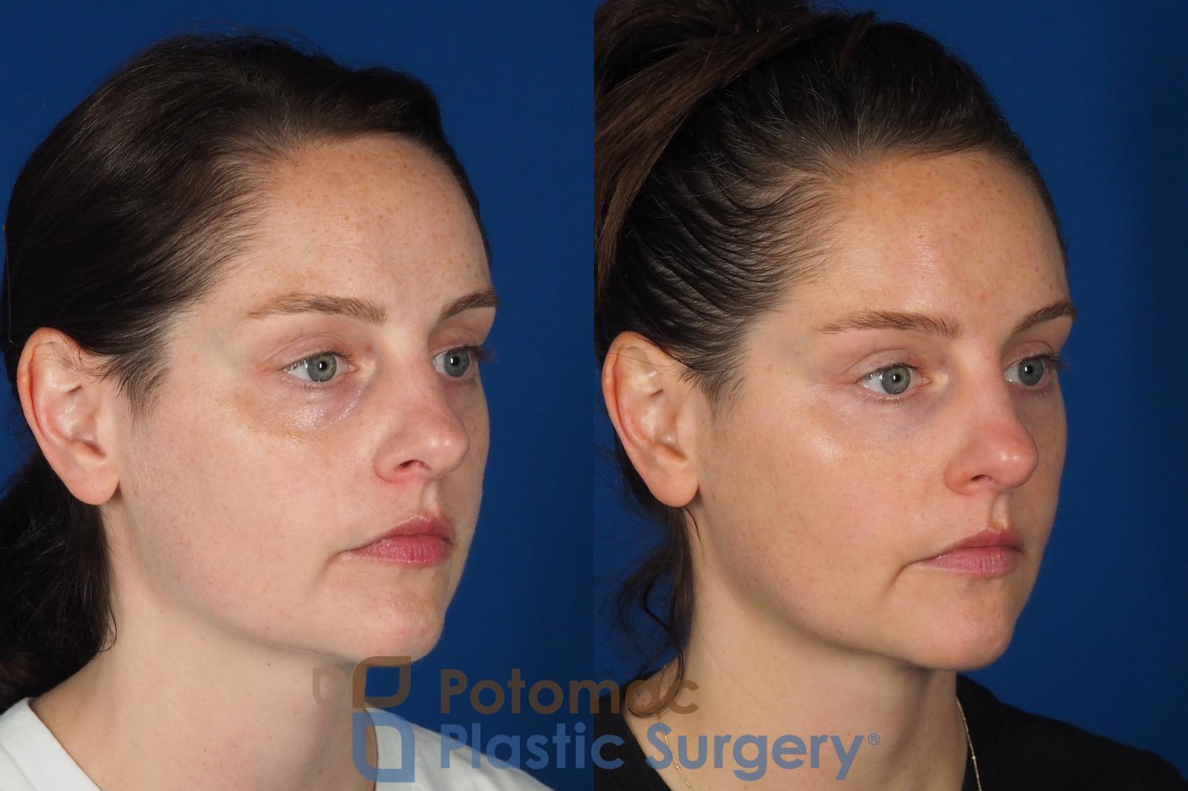 Before & After Dermal Fillers Case 332 Right Oblique View in Washington DC & Arlington , DC