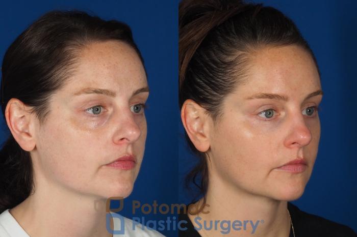 Before & After Dermal Fillers Case 332 Right Oblique View in Washington DC & Arlington , DC