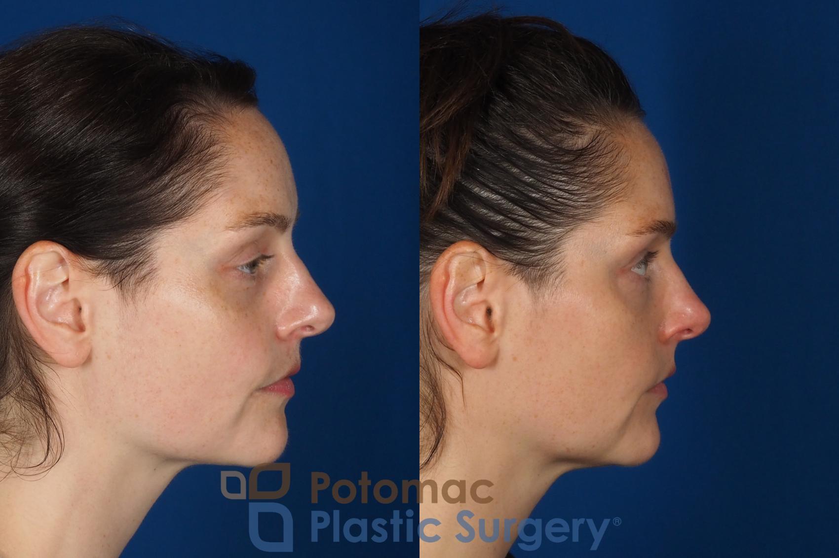 Before & After Dermal Fillers Case 332 Right Side View in Washington DC & Arlington , DC