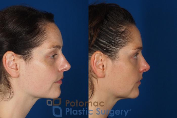 Before & After Dermal Fillers Case 332 Right Side View in Washington DC & Arlington , DC