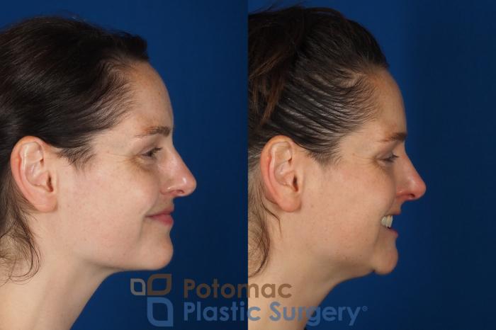 Before & After Dermal Fillers Case 332 Right - Smiling View in Washington DC & Arlington , DC