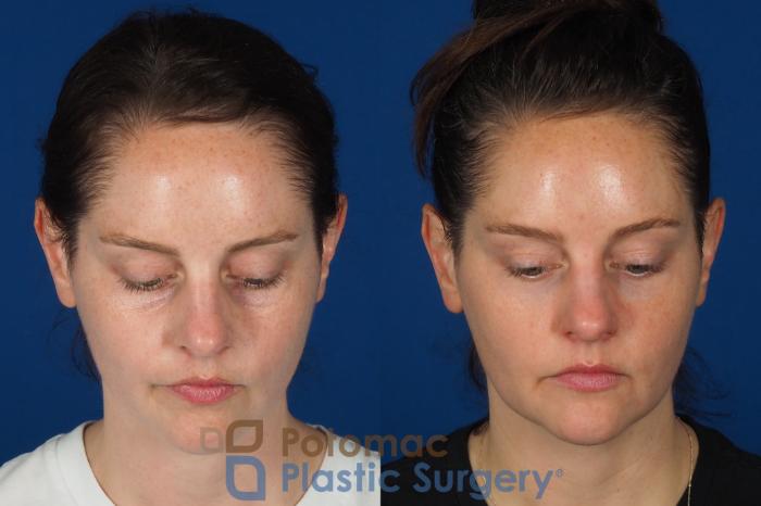 Before & After Dermal Fillers Case 332 Top View in Washington DC & Arlington , DC