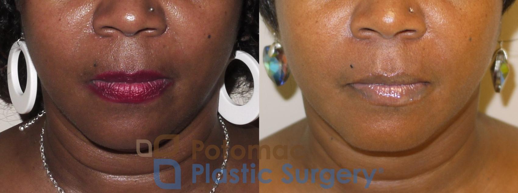 Before & After Dermal Fillers Case 35 Front View in Washington DC & Arlington , DC