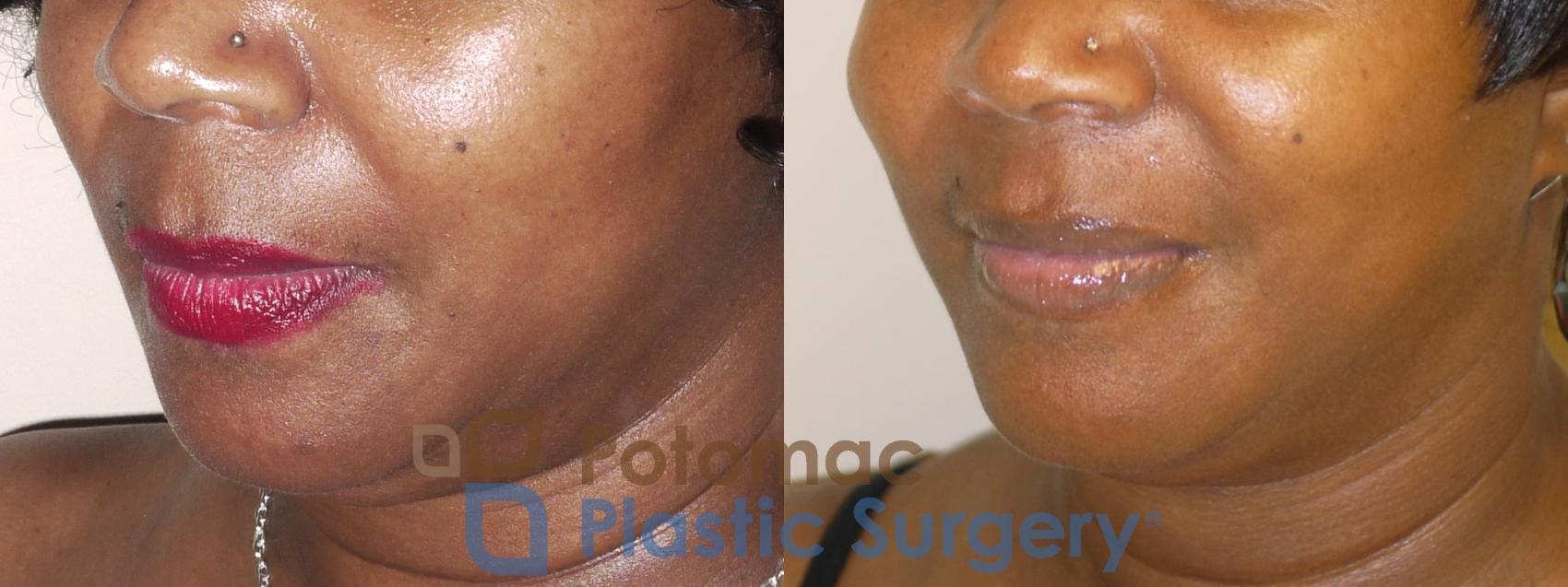 Facial filler injection for treating smile lines and thinning lips in a