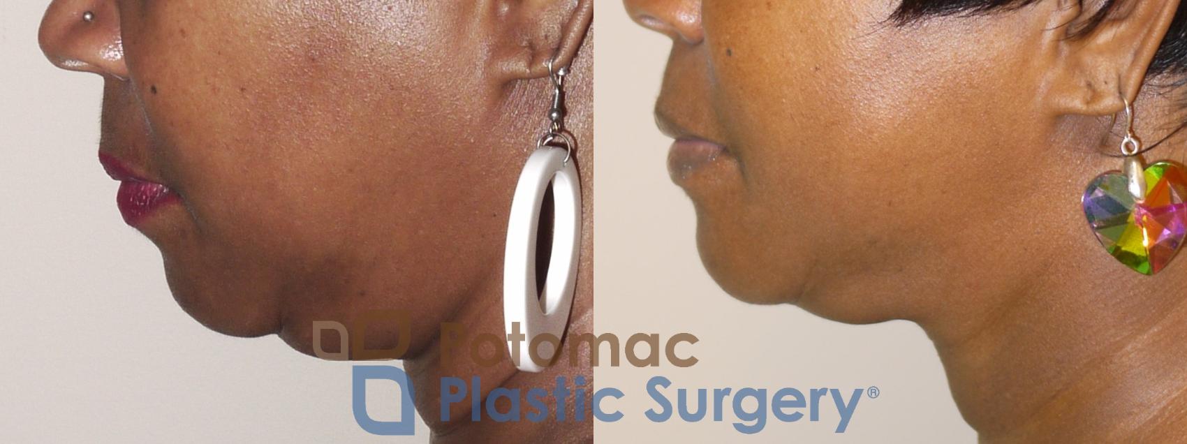 Before & After Dermal Fillers Case 35 Left Side View in Washington DC & Arlington , DC