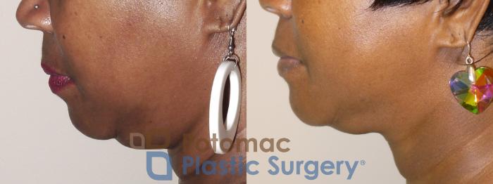 Before & After Lip Augmentation Case 35 Left Side View in Washington, DC