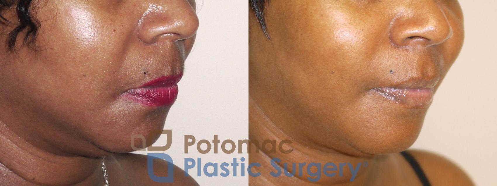 Facial filler injection for treating smile lines and thinning lips in a