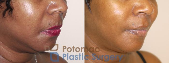 Before & After Dermal Fillers Case 35 Right Oblique View in Washington DC & Arlington , DC
