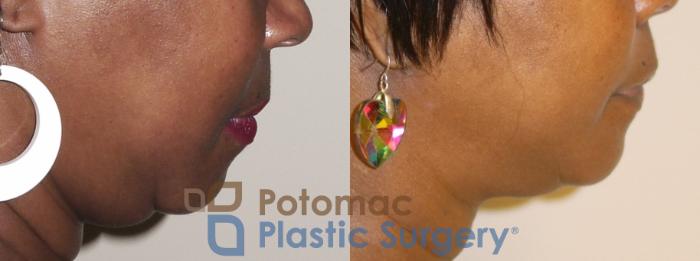 Before & After Lip Augmentation Case 35 Right Side View in Washington, DC