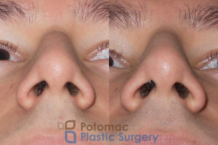 Before & After Rhinoplasty - Cosmetic Case 38 Below View in Washington, DC
