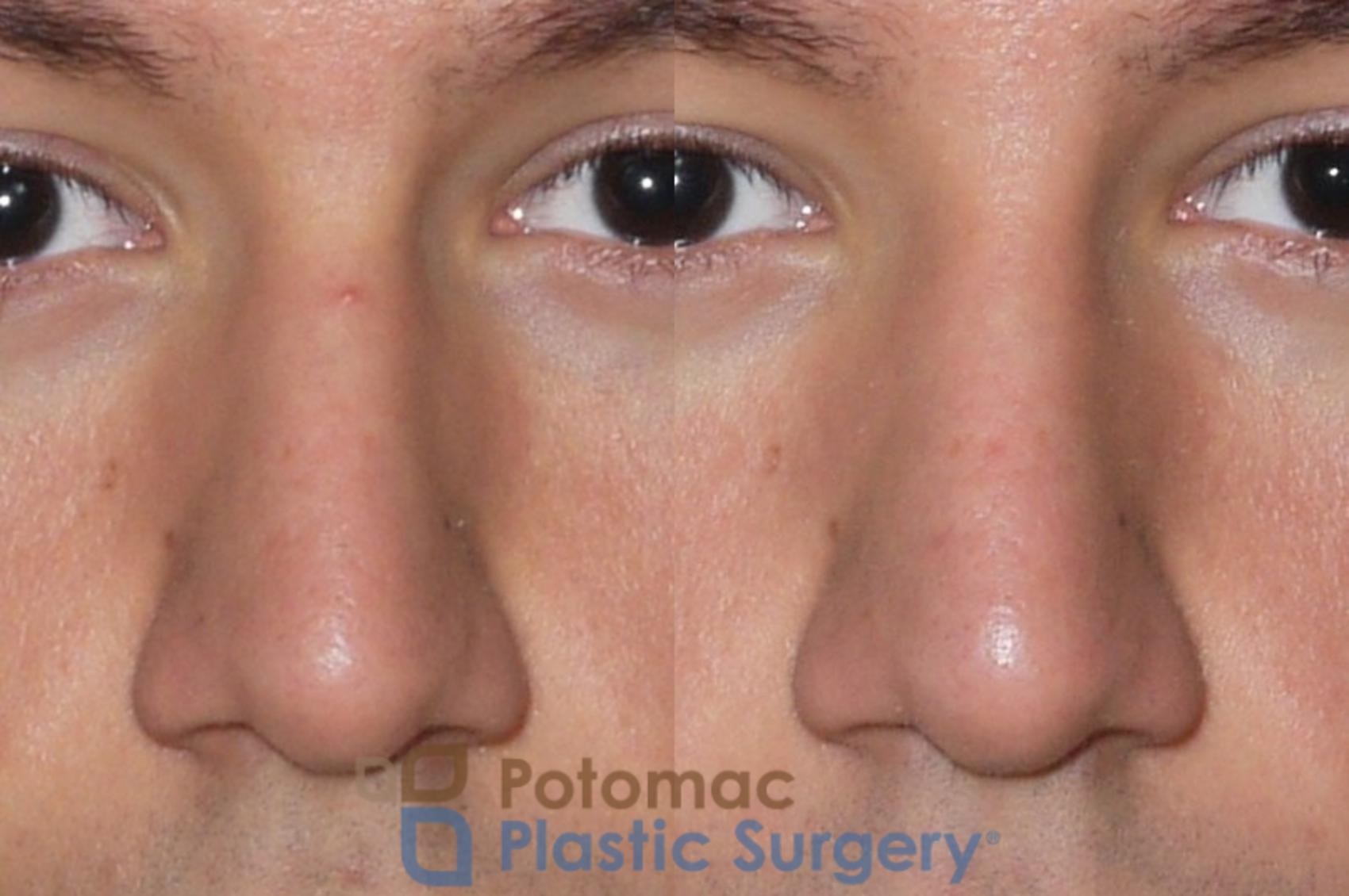 Before & After Rhinoplasty - Cosmetic Case 38 Front View in Washington, DC