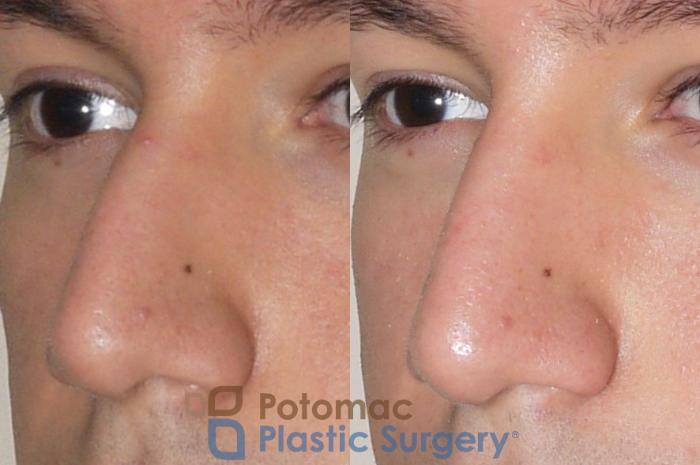 Before & After Rhinoplasty - Cosmetic Case 38 Left Oblique View in Washington, DC