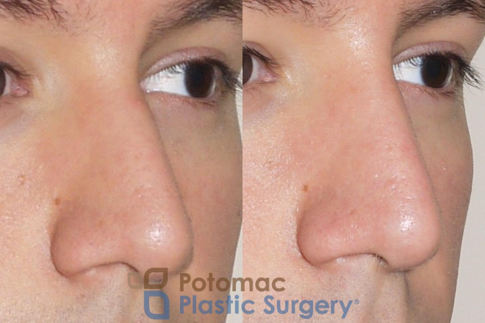 Before & After Dermal Fillers Case 38 Right Oblique View in Washington, DC