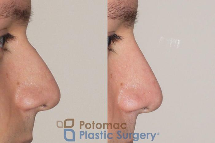 Before & After Rhinoplasty - Cosmetic Case 38 Right Side View in Washington, DC