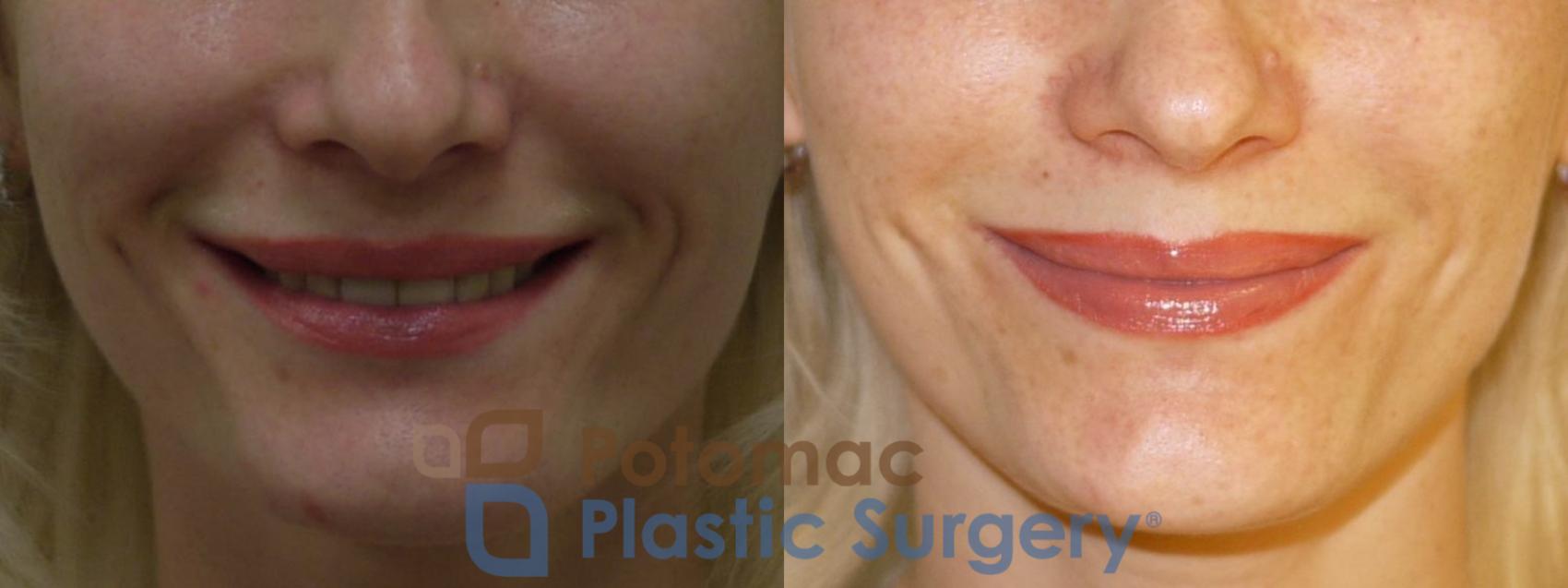 Before & After Liquid Facelift Case 73 Front - Smiling View in Washington DC & Arlington , DC